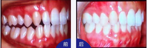 牙齿矫正前后对比
