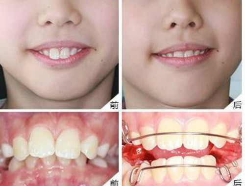 牙齿健康科普：儿童牙矫正有几个关键时期？！