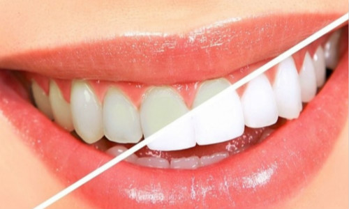 导致牙齿变黄的原因以及清洁牙齿的方法介绍