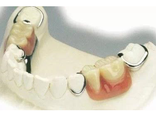 牙齿长期缺失会有哪些影响