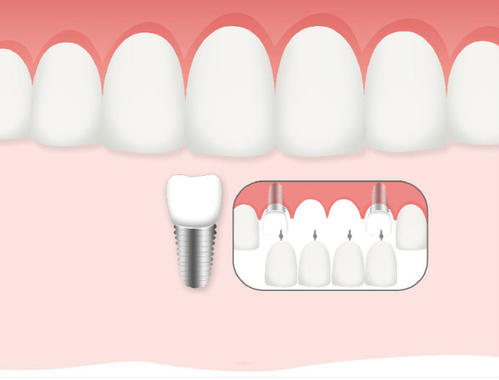 种植牙后该如何护理和保养，一般做种植牙术后要注意哪些事项?
