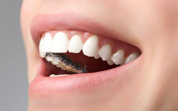 牙齿不整齐，什么方法能矫正？