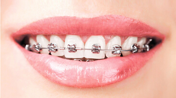 牙齿矫正之：陶瓷托槽矫正和金属托槽矫正的区别