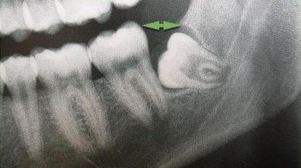 微创拔牙和普通拔牙手术有哪些区别