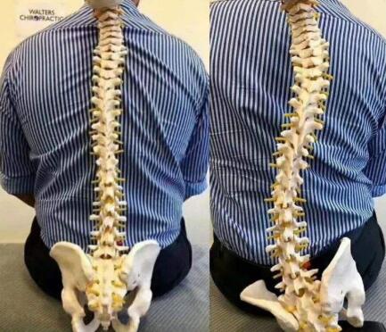 脊柱侧凸这种病症如何进行康复训练？