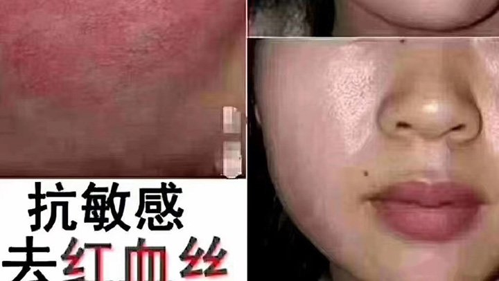 去红血丝找岚琳美容