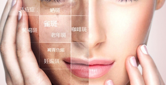 女人脸上的色斑怎么快速祛除 祛斑方式介绍