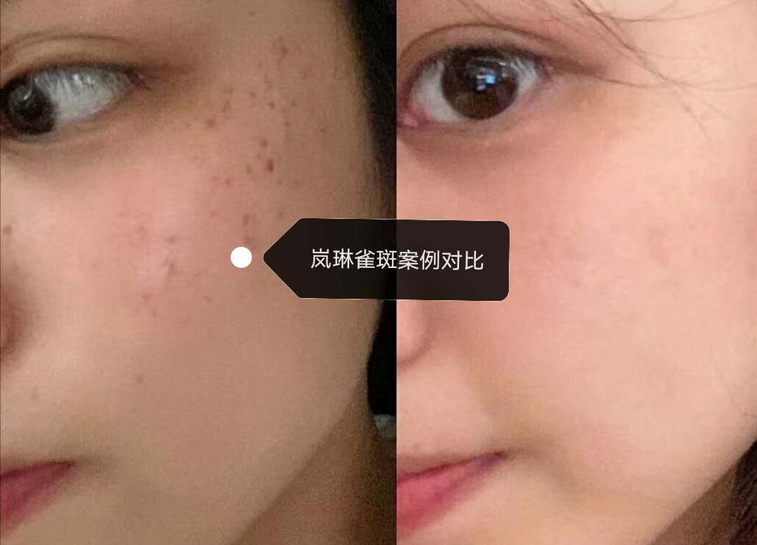祛雀斑找岚琳美容
