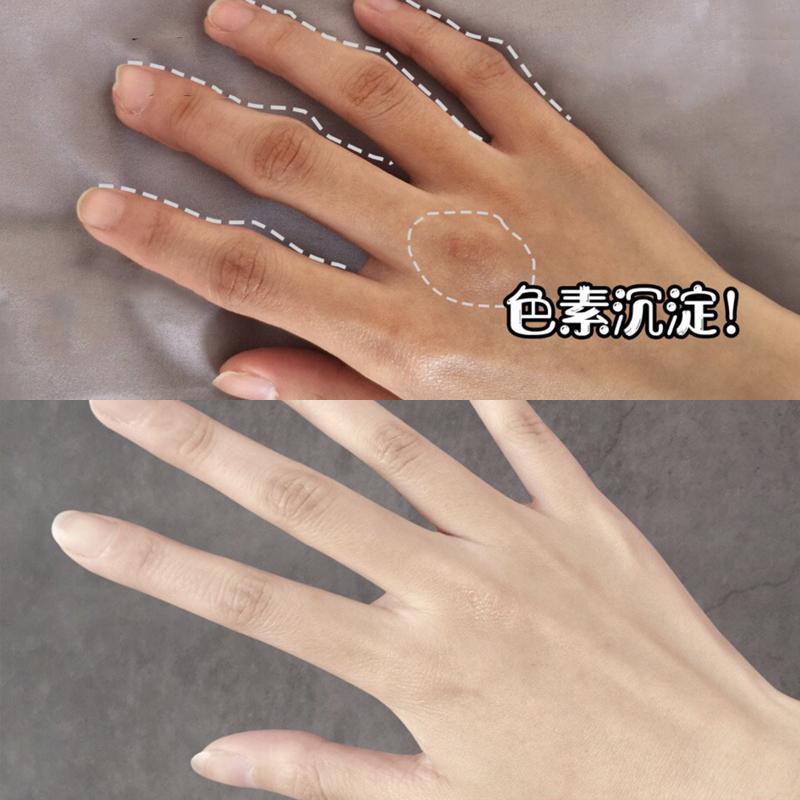 合肥去黑色素