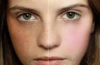 皮肤老是长斑需要注意什么？注意这些让你告别加斑