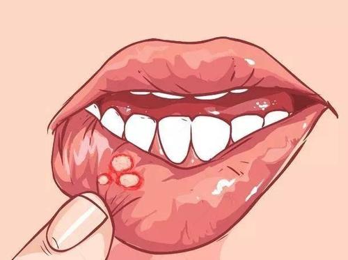 放几滴血，口腔溃疡就会痊愈吗？