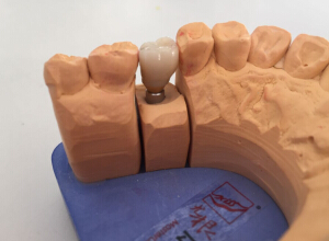 镶牙之前口腔内的残根应该怎样处理？