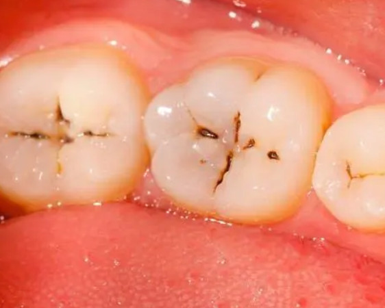 如何治疗牙齿上的黑洞?