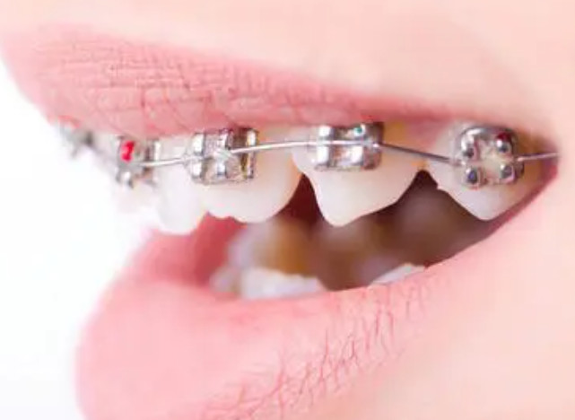 什么时候可以做牙齿正畸?牙齿不齐的原因有哪些?