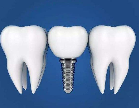 这五点因素会影响种植牙的使用寿命!
