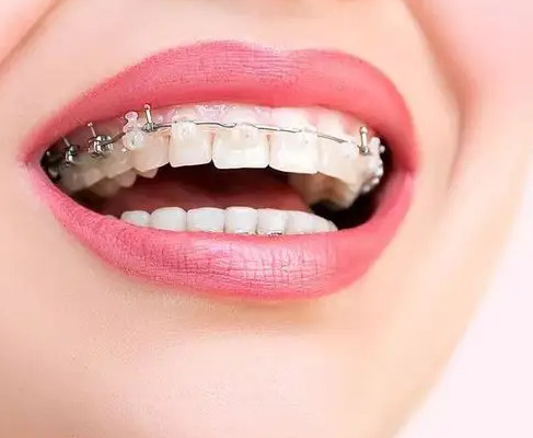牙齿正畸后真的会反弹吗？