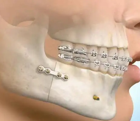 哪些情况是需要通过拔牙来进行矫正的？