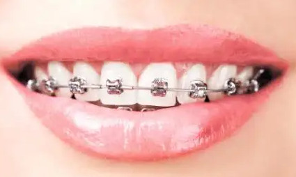 牙正畸的9个误区！你信了几个？
