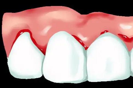 牙龈总出血是怎么回事?如何避免牙龈出血?