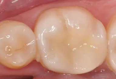 为什么补牙的时候牙医要磨牙？