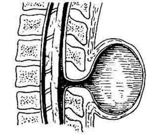 河南脊髓囊状突出