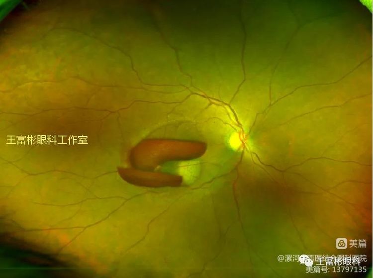 OCT：“视网膜前间隙”相关的其中几种眼病