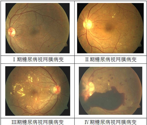 糖尿病性视网膜病变的易患因素和危害性