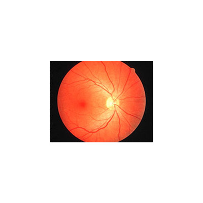 糖尿病性视网膜病变的症状和造成症状的原因
