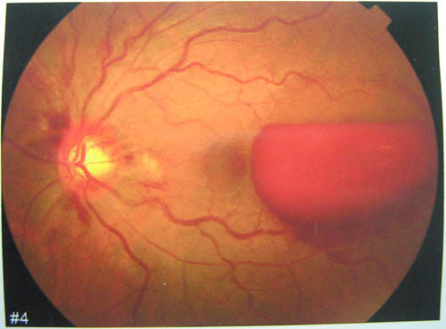 漯河眼底黄斑变性医师提醒您：按哪些穴位可以有效保护眼睛