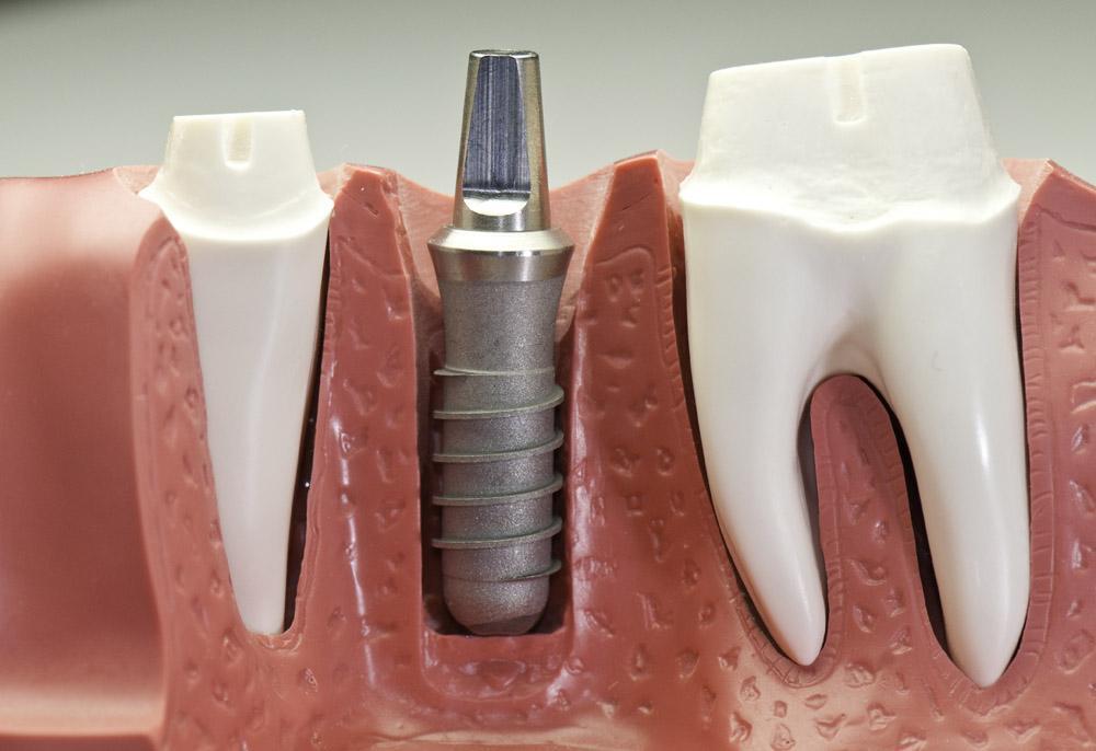 口腔医院来解答种植牙的优势和价值