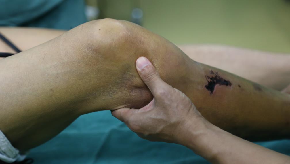 驻马店正骨医院代振动院长完成一例罕见的膝关节脱位手术