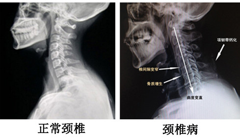 在对正常人颈椎进行健康检查或作对比研究性摄片时,常发现颈椎段可有